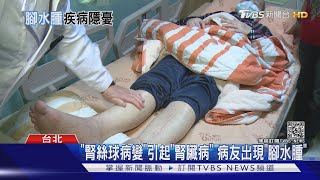 不得輕忽!這四種疾病...導致&quot;腳水腫&quot;...醫師：勿拖延! 十點不一樣 ... 