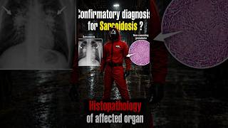 #Sarcoidosis #HealthyLife #BanglaHealth #HealthAwareness #LungHealth #StayHealthy #MedicalAwareness