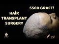 Hair transplant in istanbul  esteticium