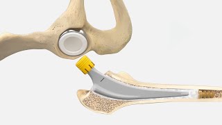 AESCULAP® Bipolar Cup & Excia® T Cemented