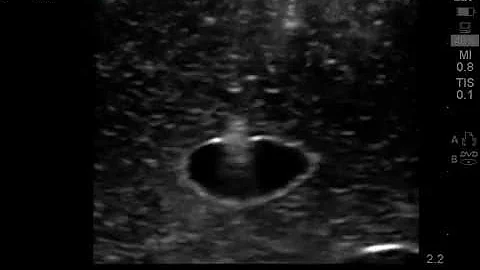 Ultrasound guided vascular access- Out of Plane (axial/ transverse) view