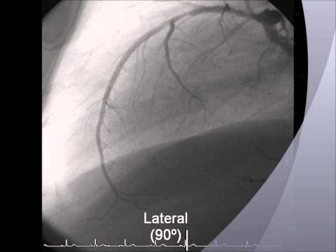 Proyecciones en la Coronariografía - Cateterismo