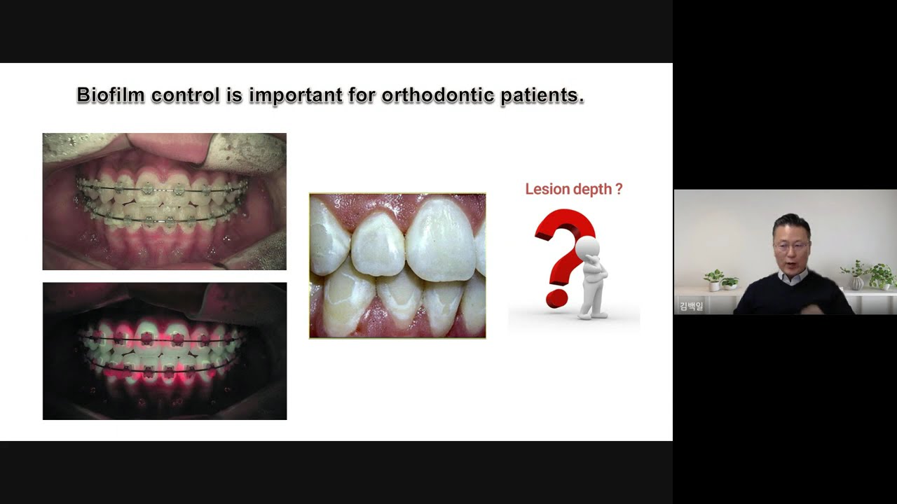 [AIOBIO] QBLISS Clinical Series | Episode 3 – Early Tooth Decay Detection With QBLISS/QLF
