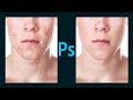 Retouch acne with basic tools in Photoshop