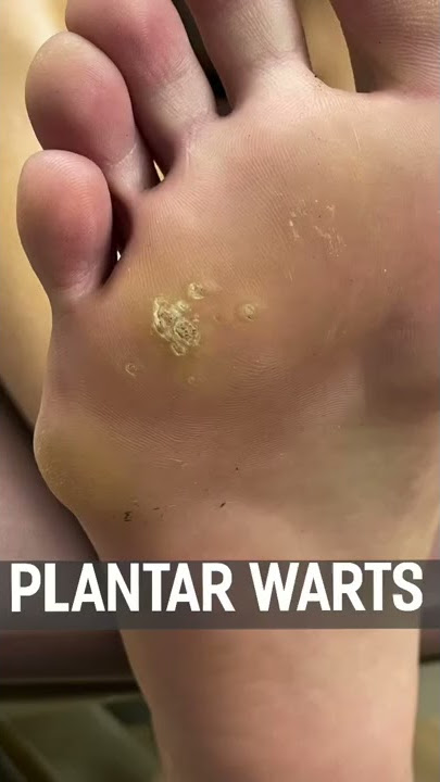 PLANTAR WARTS TREATMENT! #shorts #short
