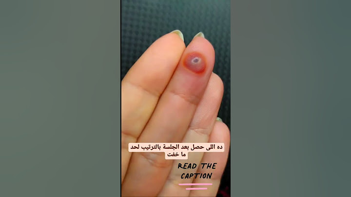 علاج الثآليل أو السنطة أو عين السمكة