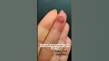 علاج الثآليل أو السنطة أو عين السمكة 