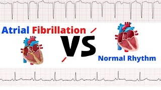 Atrial Fibrillation Vs Normal Heart Rhythm - Comparison - Made Easy.