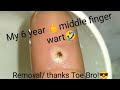 My middle 🖕🖕🖕finger wart removal🤣 with microscope finale, credit to The Toe Bro!!!