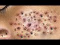 Blackhead Removal With Sac Dep Spa @10007107