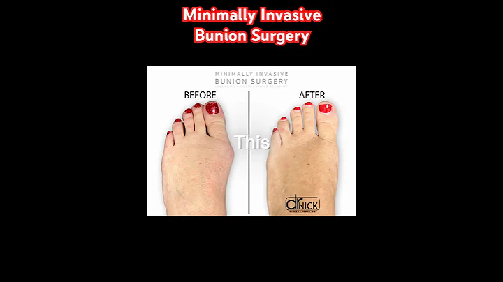 FUTRE OF BUNION SURGERY!