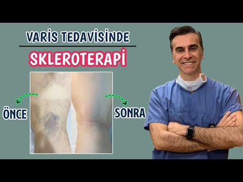 Sihir Değil! Skleroterapi Tedavisi🤩 | Varislerle İlgili Tüm Merak Edilenler