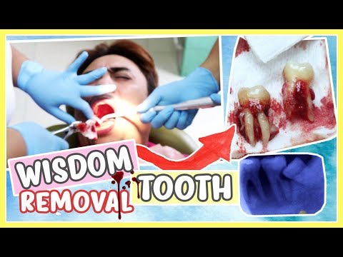 WISDOM TOOTH REMOVAL PROCESS (EXTRACTION & SURGERY) 💜 Purpleheiress