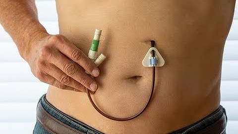 CPT code for Mechanical removal of obstructive material - Simplify Medical coding