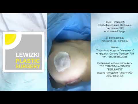 Закрытая ринопластика и увеличение груди имплантами в Центре пластической хирургии г. Киев