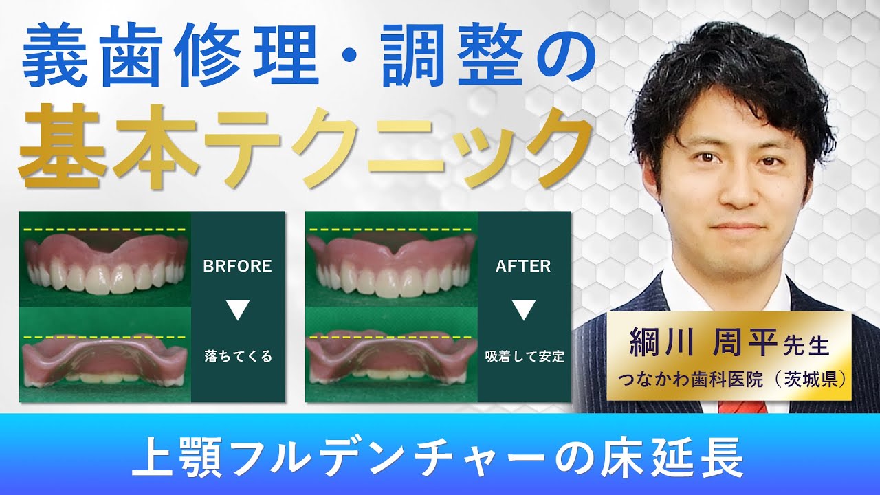 部分床義歯のトラブル解消法 : 患者さんと一緒に調整する部分床義歯の修理調整法 失敗しないために” 部分床義歯のトラブル＆リカバリー