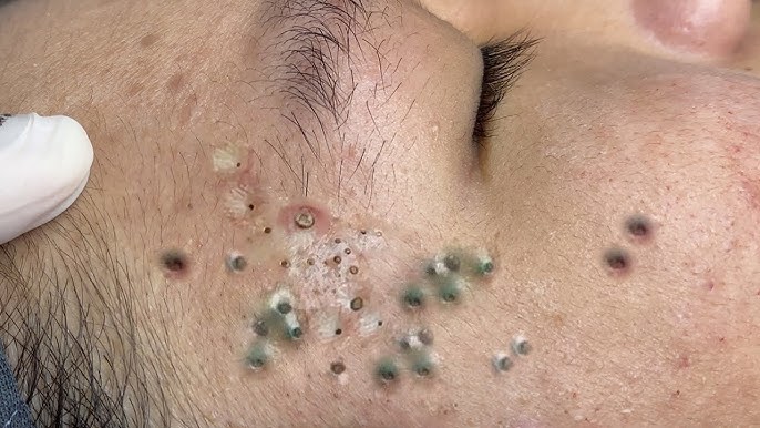 Blackheads & Acne Treatment 04.05.2024 (Part 7) #blackhead #whitehead #acne #blackheadremoval - YouTube
