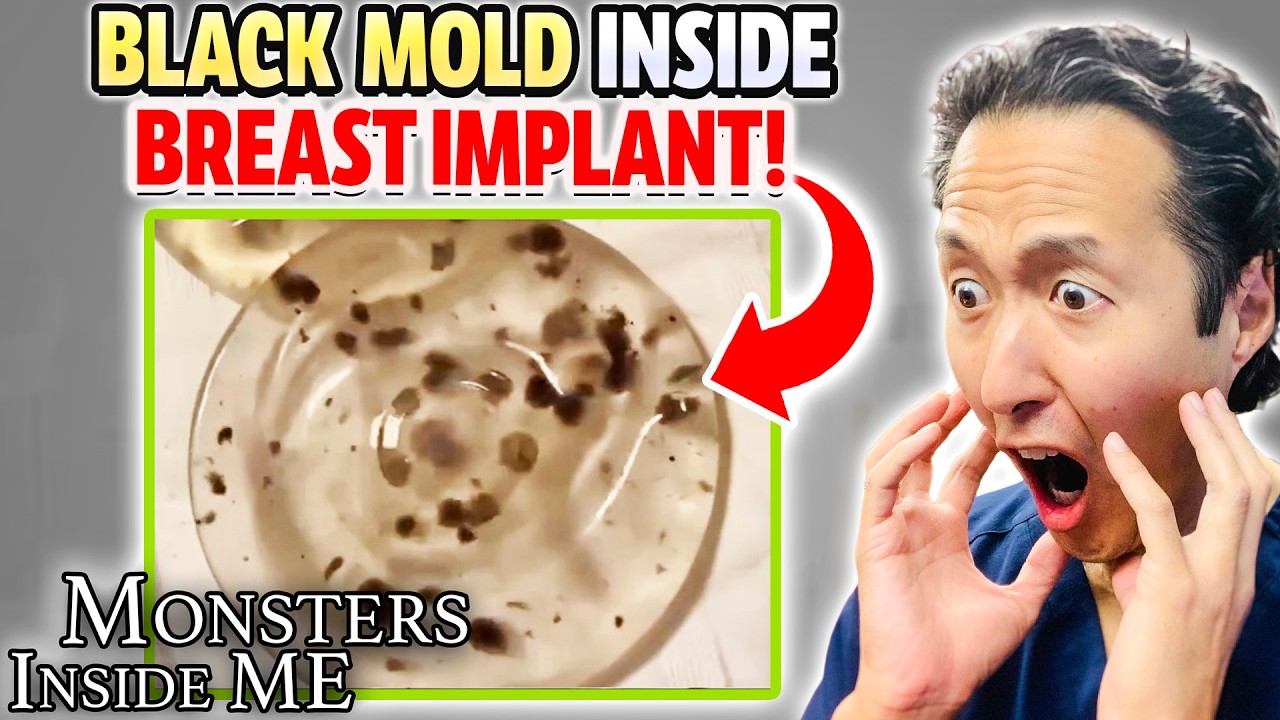 BLACK MOLD in Breast Implants! Plastic Surgeon Reacts to MONSTERS INSIDE ME BLACK MOLD in Breast Implants! Plastic Surgeon Reacts to MONSTERS INSIDE ME