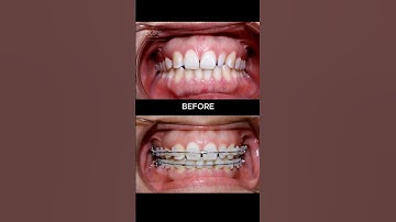 Niềng răng điều trị cười hở lợi và giảm hô #braces #orthodontist #niengrang #dentist #dental