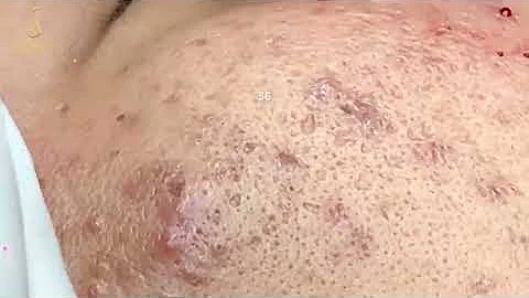 Get rid of BLACKHEADS for the LONGEST time, 44 min...