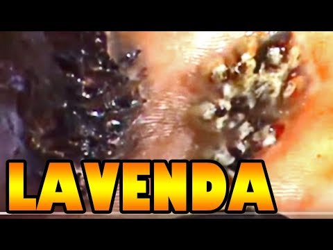 Little Lavenda of Sirisia Bok Amazing Jigger Treatment Little Lavenda of Sirisia Bok Amazing Jigger Treatment