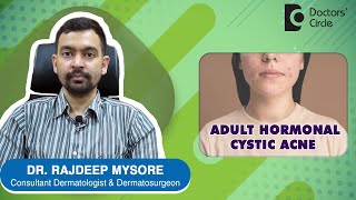 ADULT HORMONAL CYSTIC ACNE. Causes & Treatment from Dermatologist-Dr.Rajdeep Mysore| Doctors' Circle