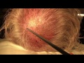 Crown Hair Transplant Design Explained in Dallas, TX