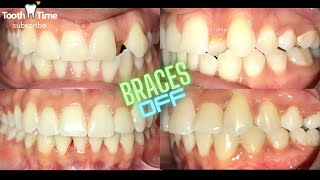 Braces off - 16 months with braces Amazing results - Tooth Time Family Dentistry New Braunfels