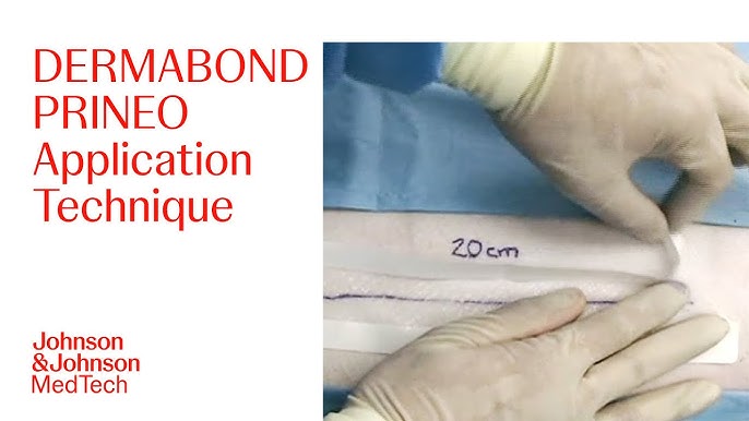 Step-by-Step Guide for Effective Application of DERMABOND PRINEO Skin  Closure System