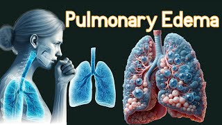 Pulmonary Edema (Fluid In the Lungs) Symptoms & causes