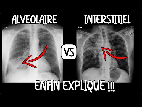 Vidéo: Radiographie thoracique