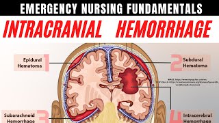 ⚡Intracranial Hemorrhage⚡ Hemorrhagic Strokes ⚡ Emergency Nurse Tips! Brain Bleeds Explained! ✅ screenshot 5