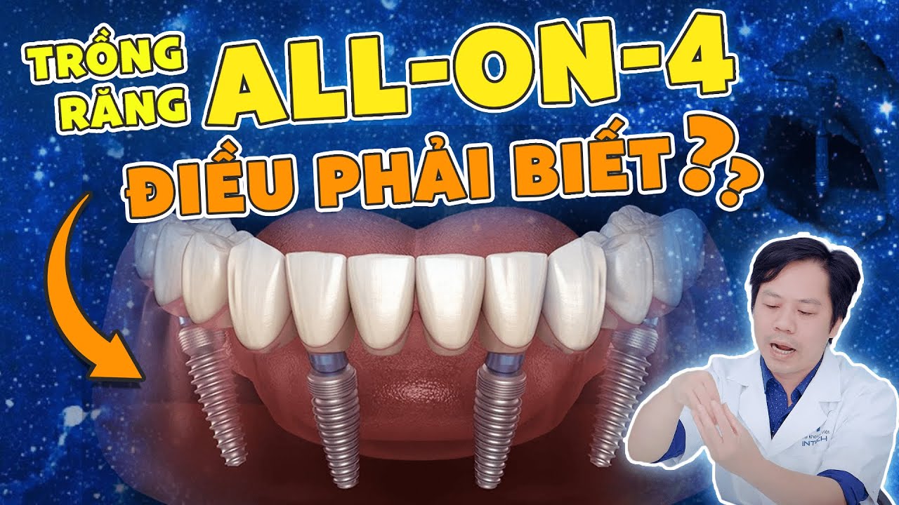 Outline Video Trồng Răng Implant Toàn Hàm All-On-4: 05 Điều “Bắt Buộc” Phải Biết Trước Khi Trồng Răng Toàn Hàm