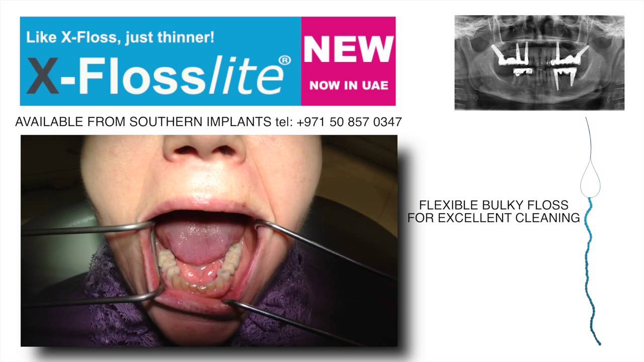 Cleaning your implant bridges with XFloss YouTube