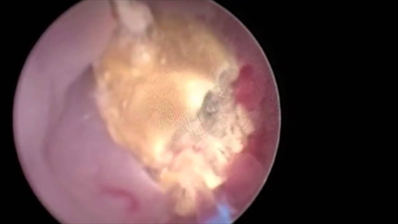 CALCULO RENAL Ureterorrenolitotripsia