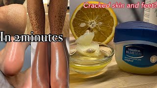 How to get rid of cracked legs | cracked legs Cracked Heels Cracked skin cracked feet home remedies