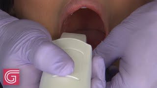 How to Pre-treatment Scan Lower Arch for Beginners