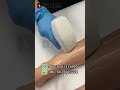 laser hair removal before and after| Shisedo Beauty Instrument | Huixian, China#laserhairremoval