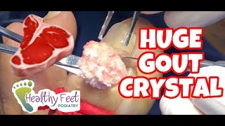Removing Gout Crystals & How to Prevent Gout
