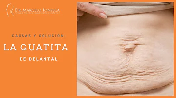 ¿Se puede aplanar una barriga de delantal?