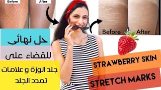 حل نهائي للقضاء على جلد الوزة و علامات تمدد الجلد /stretch marks & strawberry skin