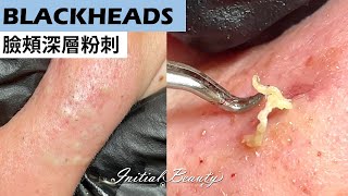 臉頰深層粉刺( blackheads ) - Taiwan Tainan台南清粉刺最乾淨