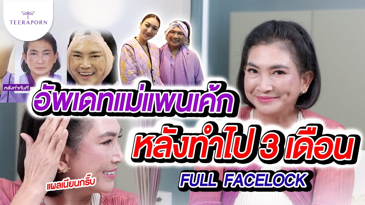 อัพเดทแม่แพนเค้ก หลังดึงหน้าไป 3 เดือน คลิปตัวเต็ม ธีรพรคลินิก หมอชลธิศ