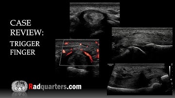 Ultrasound of Trigger Finger (Stenosing Tenosynovitis)