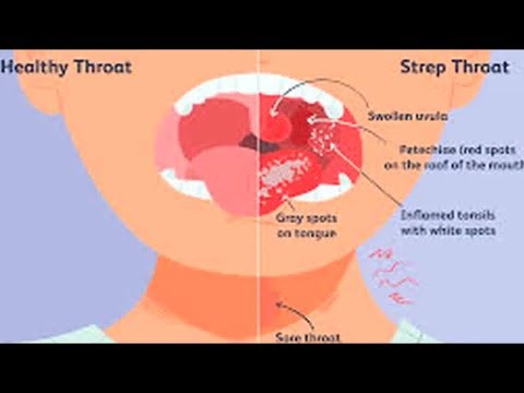 Nurse Jenn tells you everything you need to know about strep throat