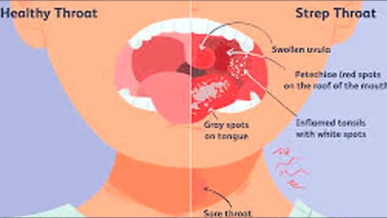 Nurse Jenn tells you everything you need to know about strep throat ...