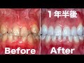 八重歯 Vampire tooth GVBDO  Before & After Braces -Time Lapse -370 Days ガチャ歯のOLが復活した歯列矯正