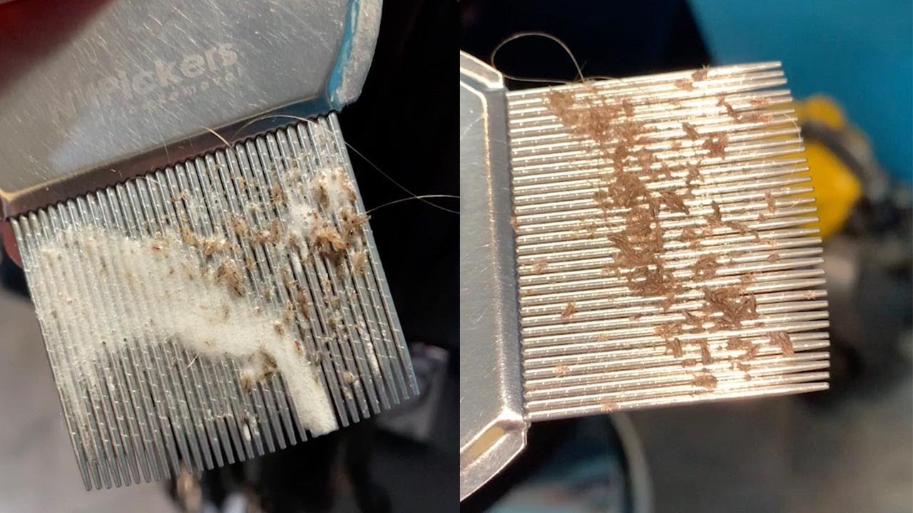 Close Up Of Lice Infestation Removal YouTube Close Up Of Lice Infestation Removal YouTube