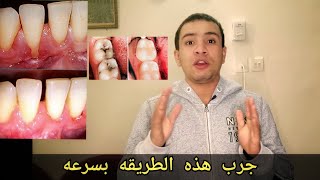 طريقه سحريه تخلصك من ( حساسيه الاسنان - تراجع اللثه - تسوس الأسنان - التهاب اللثه) خلال اسبوع