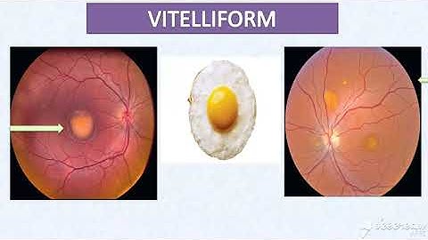 OPHTHAL BYTES - BEST VITELLIFORM MACULAR  DYSTROPHY - EYETODAY